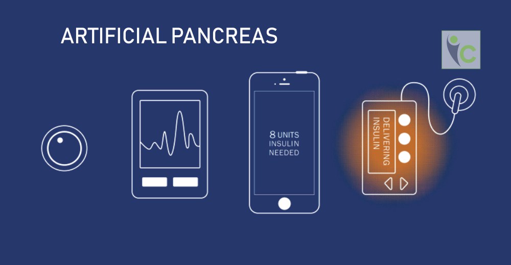 3 Things to Known about Artificial Pancreas | Insights Care