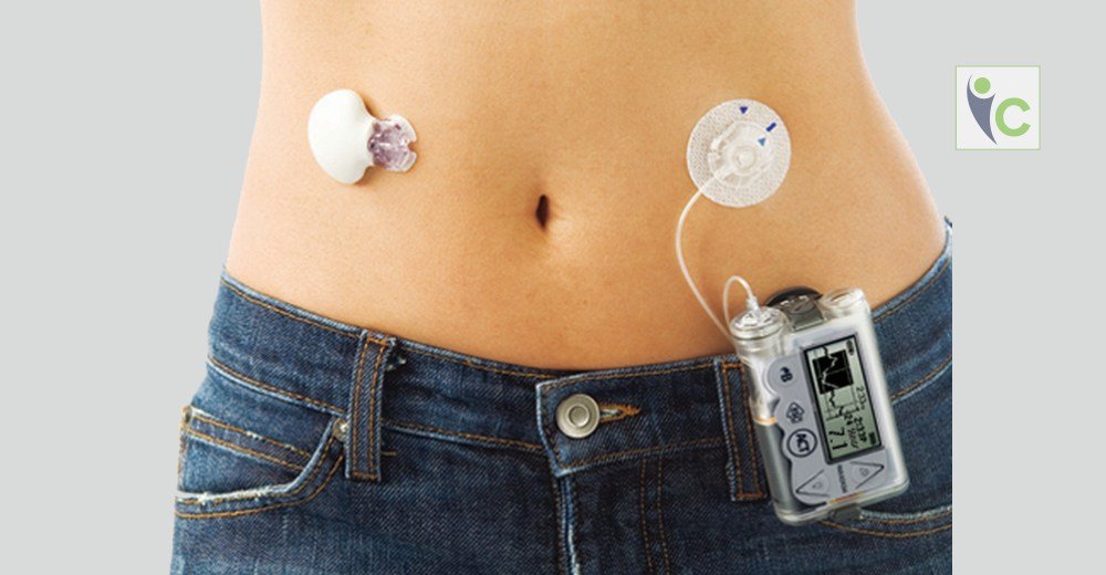 3 Things to Known about Artificial Pancreas | Insights Care