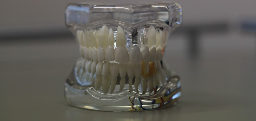 When Do You Need Dental Implants
