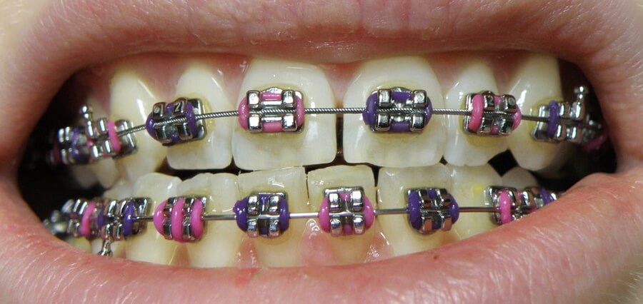 Read more about the article What To Expect and What to Get (Braces Edition)