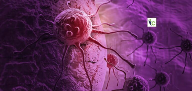 Pancreatic Cancer -AI Aids in the Early Detection | Insights Care |2022