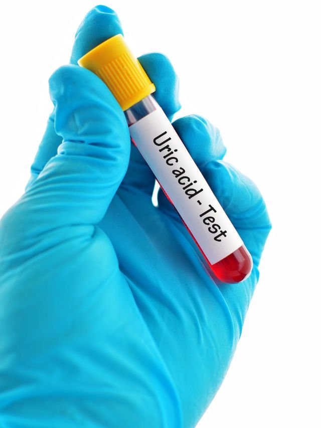 Uric Acid