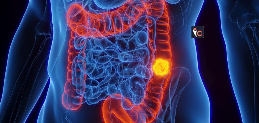 Colon Cancer Emerging as Biggest Death Cause in the Young: Colorado Doctors