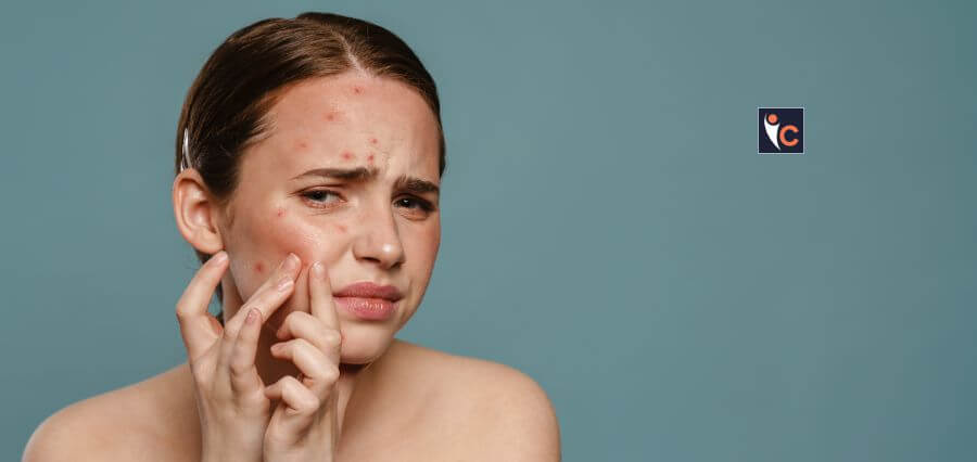 Women with Acne can Enhance Better Life Quality with Antioxidant-rich diets