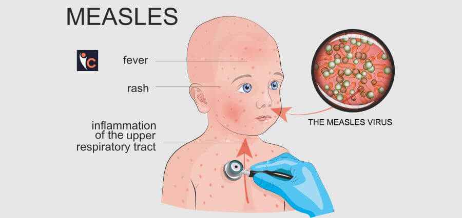 Health Officials from New Hampshire Caution of Possible Measles Exposure