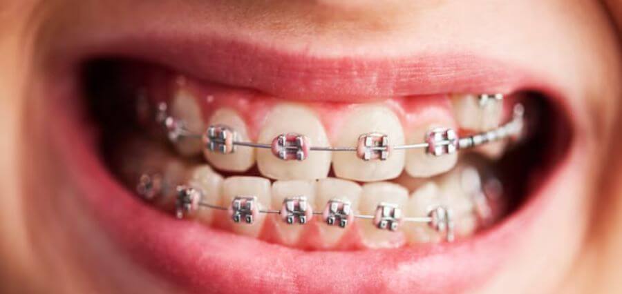 Traditional Braces