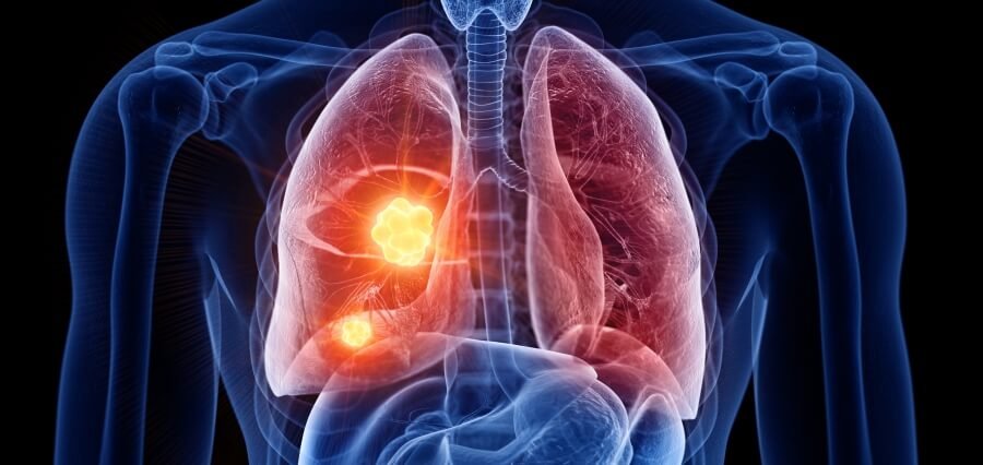 Lung Cancer Rising in Non-smokers also Researchers